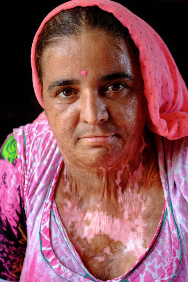 Photo title : Acid burn. Place : Jodhpur area, Rajasthan, India